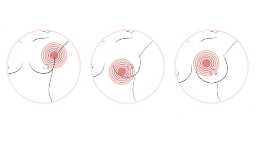 Douleurs mammaires, quand faut-il s'inquiéter ?